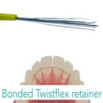 Lingual Retainer Twistflex Wire- 1pcs -China