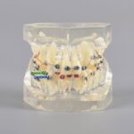 M3005 3 orthodontic model with metal bracket for demonstration